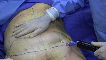 Fue sometida a procedimiento estético y la dejaron abandonada con el abdomen abierto 