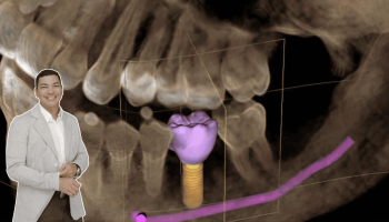 Instituto VITA impulsa Programa de Cooperación para facilitar el acceso a implantes dentales Implantología especializada a un costo más accesible para pacientes