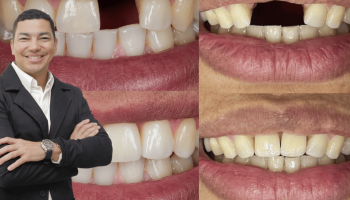 No pierdas la oportunidad de colocarte tus implantes dentales, con el programa de cooperación Vita Healthcare